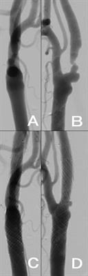 Case report: Usefulness of angioscopy in determining antiplatelet drug reduction after carotid artery stenting